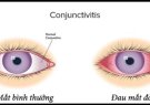CÁCH PHÒNG BỆNH ĐAU MẮT ĐỎ (HƯỚNG DẪN CỦA BỘ Y TẾ)