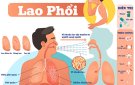 Hưởng ứng ngày chống lao thế giới 24/3. Tiến tới chấm dứt bệnh lao vào năm 2030