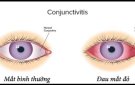 CÁCH PHÒNG BỆNH ĐAU MẮT ĐỎ (HƯỚNG DẪN CỦA BỘ Y TẾ)