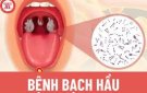 Bài tuyên truyền: Phòng, chống bệnh bạch hầu