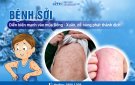 Bài tuyên truyền về bệnh Sởi và cách phòng chống
